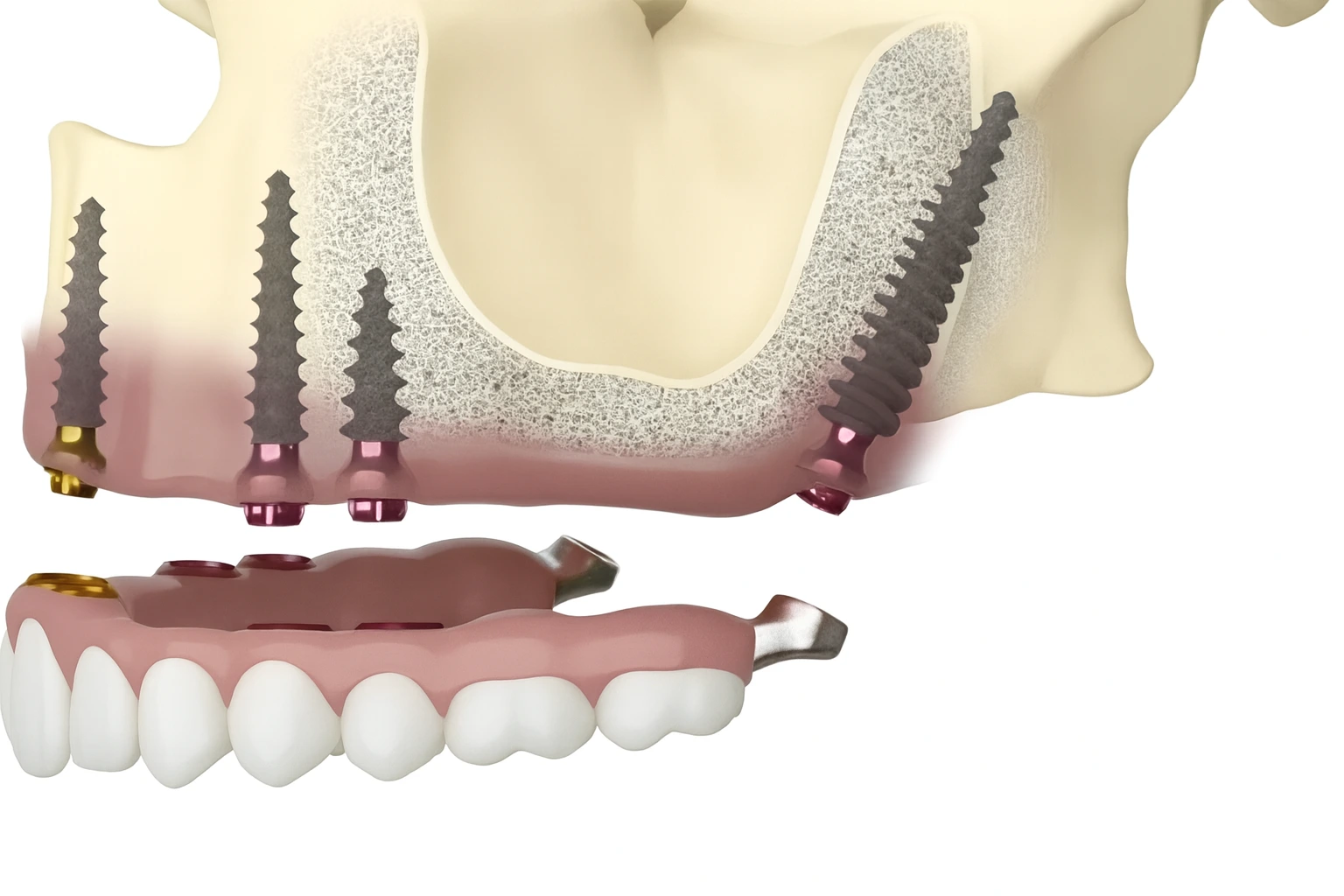 Pterygoid Implants
